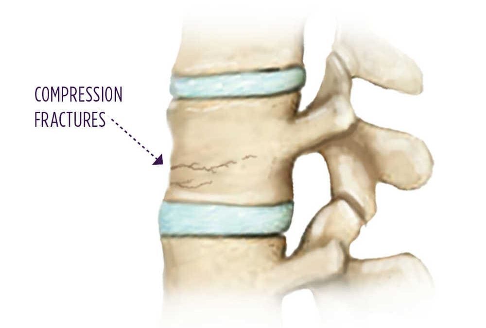 compression-fracture