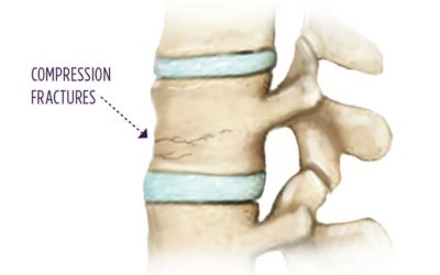 Treating Compression Fractures with Kyphoplasty