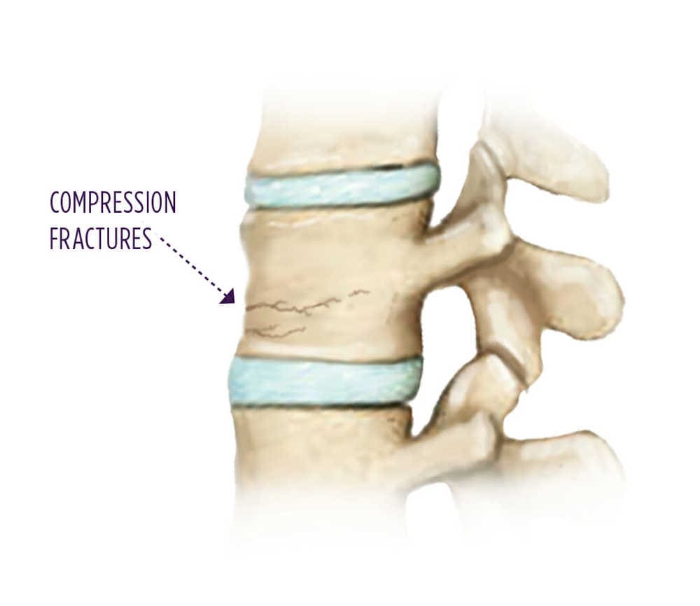 Трещина пациент. Osteoporotic vertebral Compression Fractures.