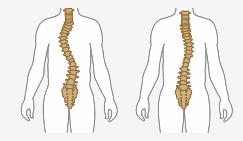Causes and Symptoms of Scoliosis