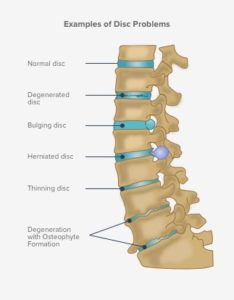 Cervical Spondylosis - Huffman Spine Clinic