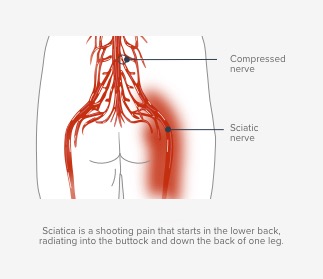 Sciatic Pain Associated with Lumbar Disc Conditions