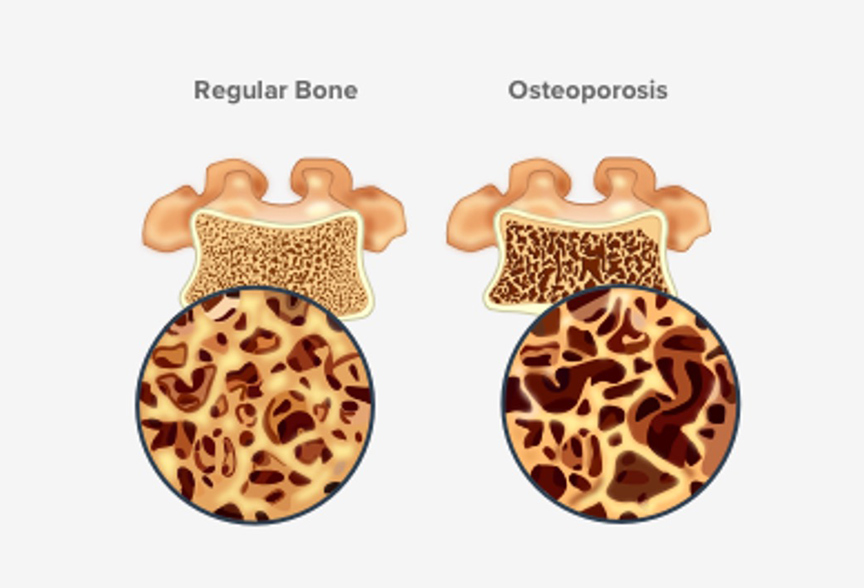 Symptoms of Osteoporosis of the Spine