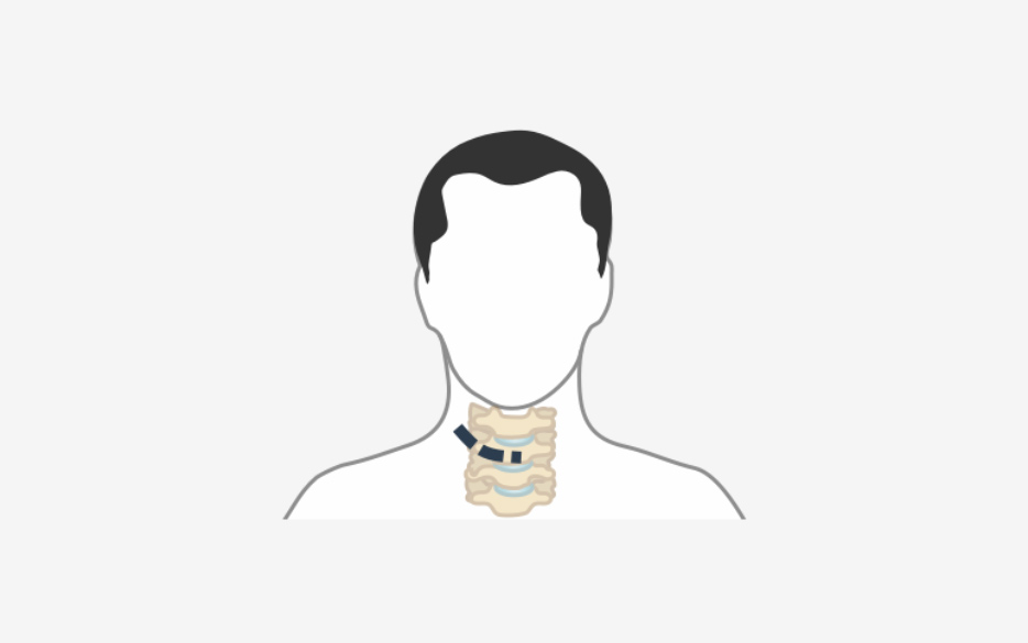 minimally-invasive-cervical-disc-replacement-image