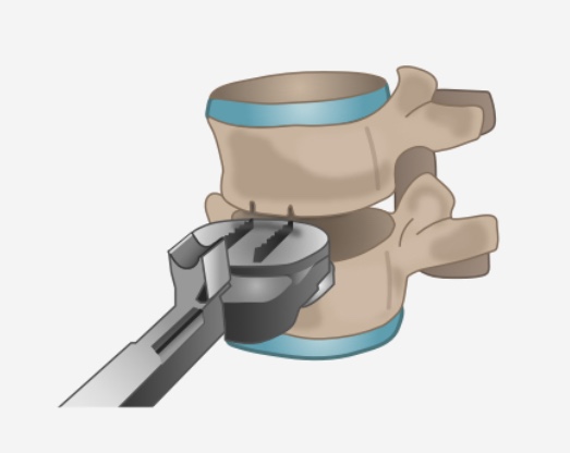 cervical-disc-replacement-image