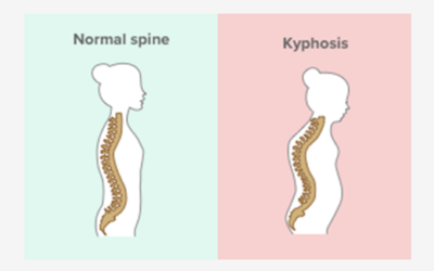 Causes and Symptoms of Spinal Fractures